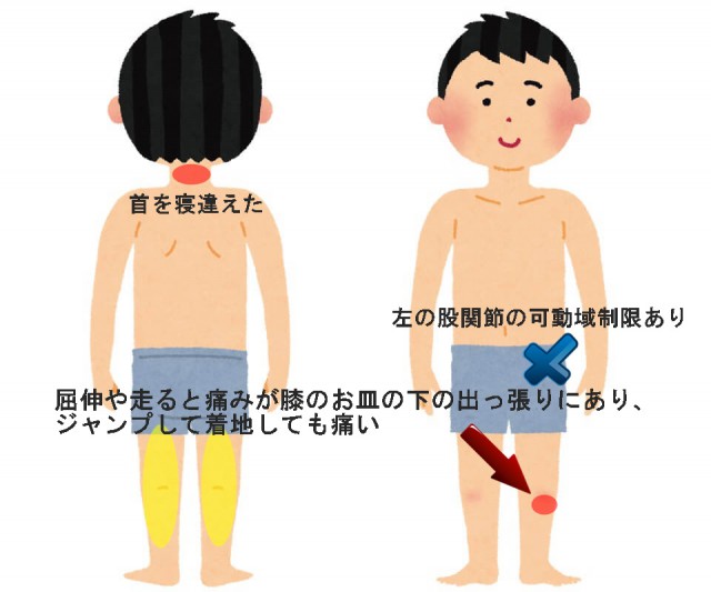 オスグッド症例その1 屈伸や走ると膝の下の出っ張りが痛い